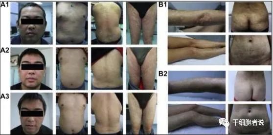 间充质干细胞银屑病复发,间充质干细胞和神经干细胞区别