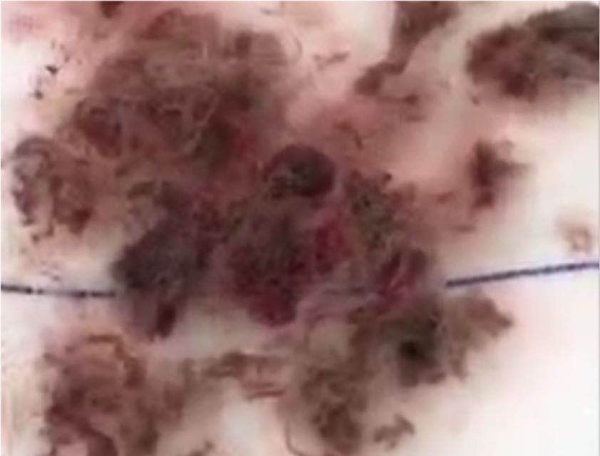 临沂一岁女孩患病,幼童被感染妇科病