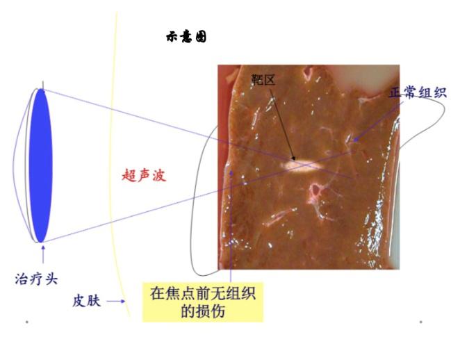 超声聚焦消融治疗肿瘤视频,高强度聚焦超声热消融肿瘤治疗