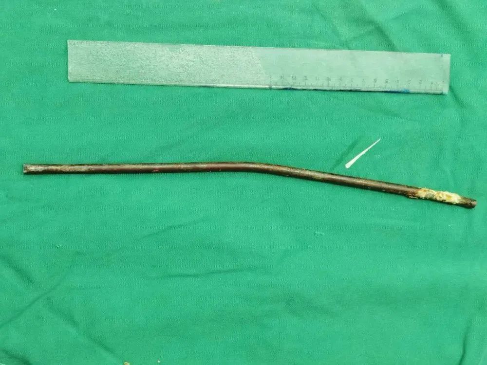 男子钢筋穿身体,男子身体插进5根钢筋救活了吗