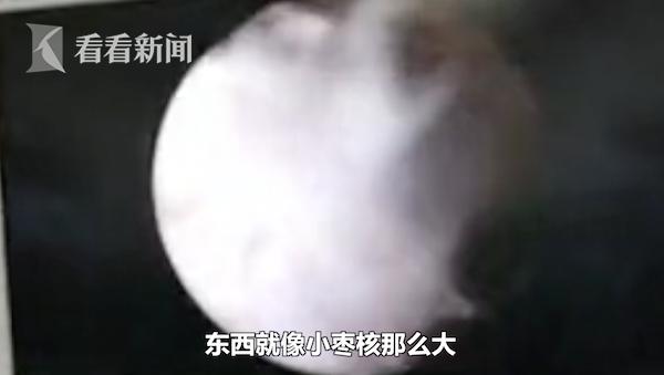 2岁女童医院检查早熟,2岁女童体下有臭味怎么回事