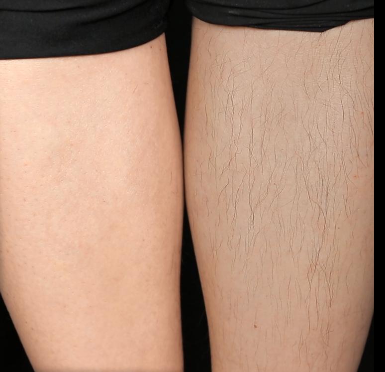 夏季脱毛用它，10分钟肌肤光滑细腻，白2度