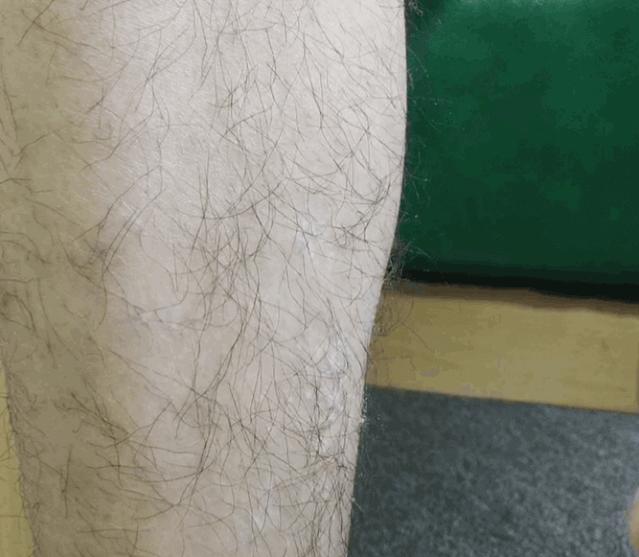 夏季脱毛用它，10分钟肌肤光滑细腻，白2度