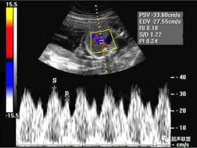 胎儿宫内窘迫如何判断,38周如何判断胎儿宫内窘迫或缺氧