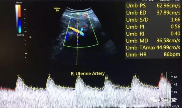 胎儿宫内窘迫如何判断,38周如何判断胎儿宫内窘迫或缺氧