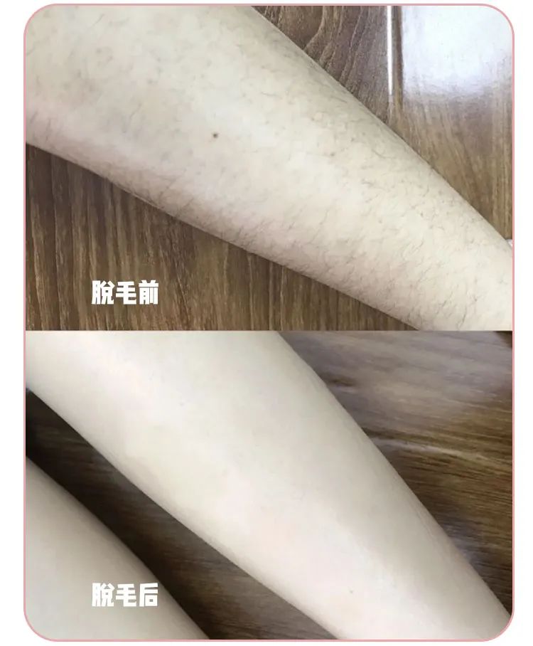 猕猴桃脱毛产品推荐,屈臣氏永久不再生毛的脱毛膏