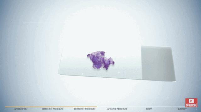 盘点医院各大科室侵入性检查：穿刺、内镜各显神通，小活检标本以“小”见“大”