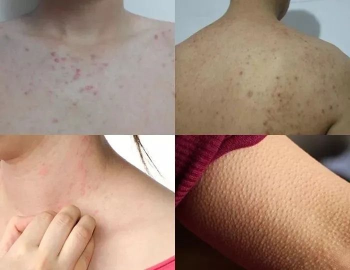 仁和药业沐浴露去螨虫,仁和除螨虫沐浴露