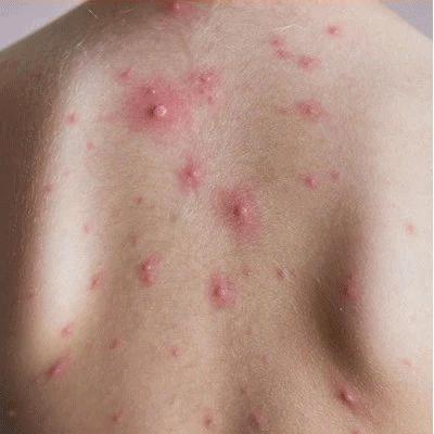 仁和药业沐浴露去螨虫,仁和除螨虫沐浴露