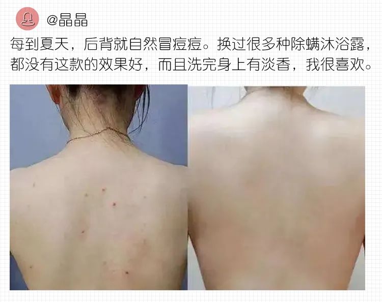 仁和药业沐浴露去螨虫,仁和除螨虫沐浴露