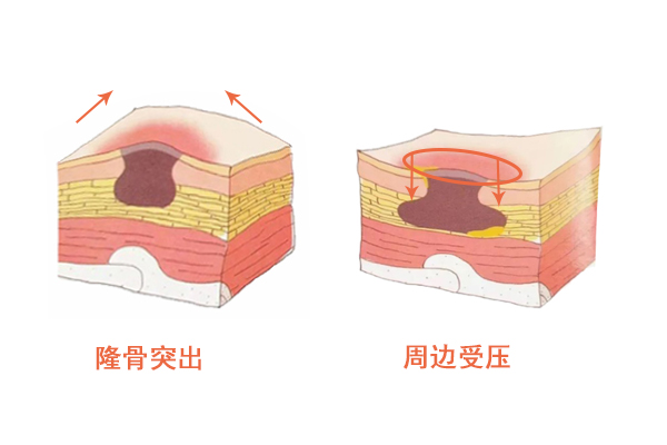 褥疮初期皮肤变黑用碘伏好吗,褥疮皮肤变黑还没破损怎么治