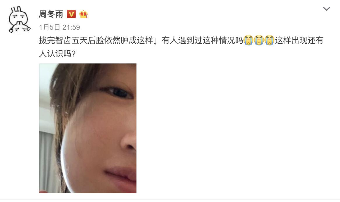 俞灏明牙龈上火脸肿,俞灏明牙龈肿胀图片