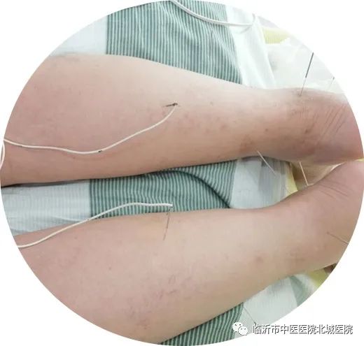 临沂市中医院医保门诊报销政策,不用医保也能报销的医院