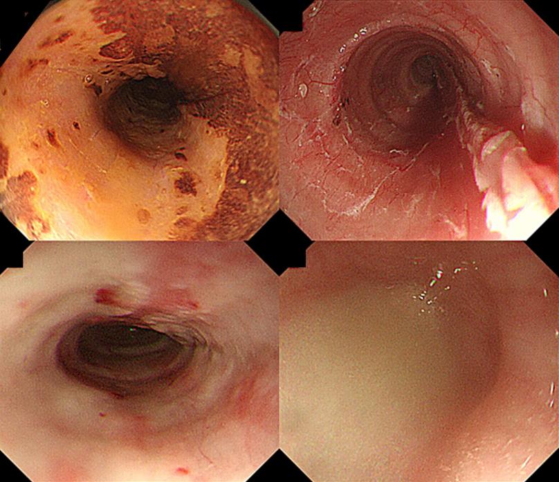 esd术后食管狭窄扩张效果,esd曲安奈德