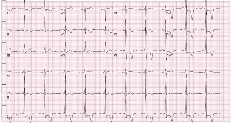 st-t改变一定就是心肌缺血吗,st-t改变是不是病理性心电图