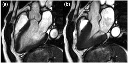 st-t改变一定就是心肌缺血吗,st-t改变是不是病理性心电图