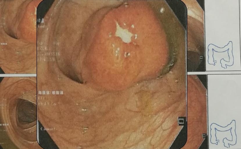 有一种口腔溃疡叫白塞病,反复口腔溃疡已经20年是白塞病吗