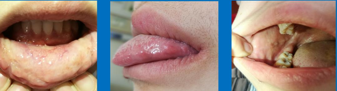 有一种口腔溃疡叫白塞病,反复口腔溃疡已经20年是白塞病吗