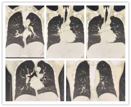 白血病浸润肺部后能治好吗,白血病浸润肝脏的超声表现