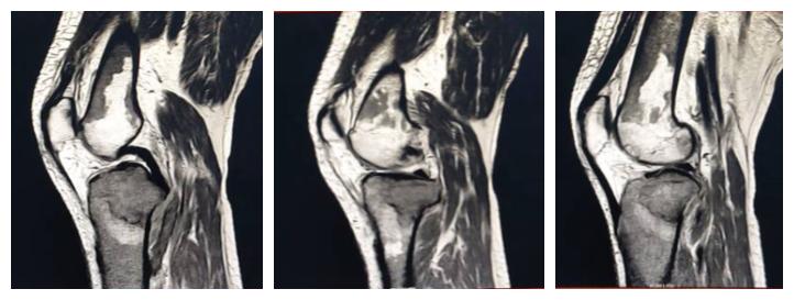 白血病浸润肺部后能治好吗,白血病浸润肝脏的超声表现