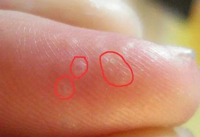 关注｜手上长水泡瘙痒难消？医生提醒：这症状夏天高发