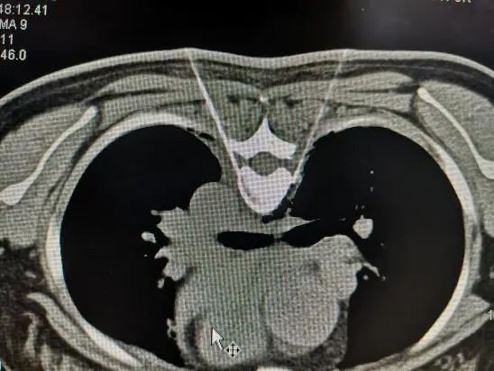 她为这病自卑了20多年，没想到神奇的两根针一扎，治好了