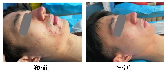 治疗青春痘中医古方也能迅速奏效,奇效火针治疗青春痘