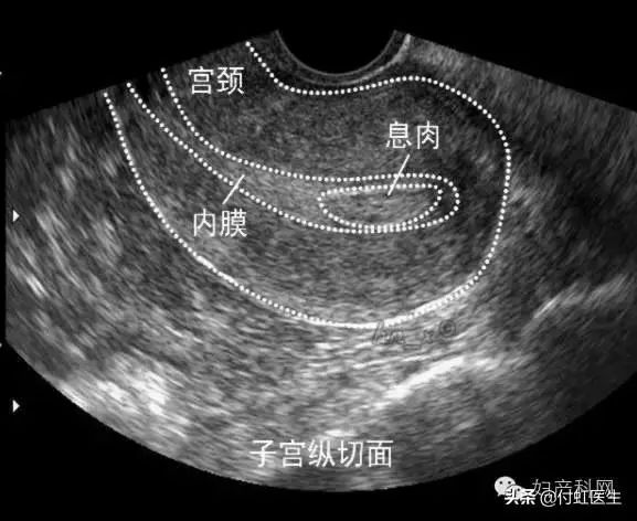 B超检查“子宫内膜回声不均”，我到底得了什么病？