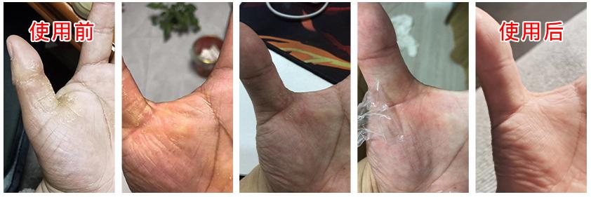 皮炎湿疹抹凡士林能抹多久,湿疹足癣用什么药膏最有效