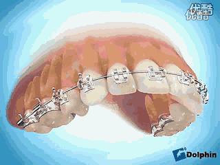 矫正牙齿有年龄限制吗,矫正牙齿的最好年龄是多少岁