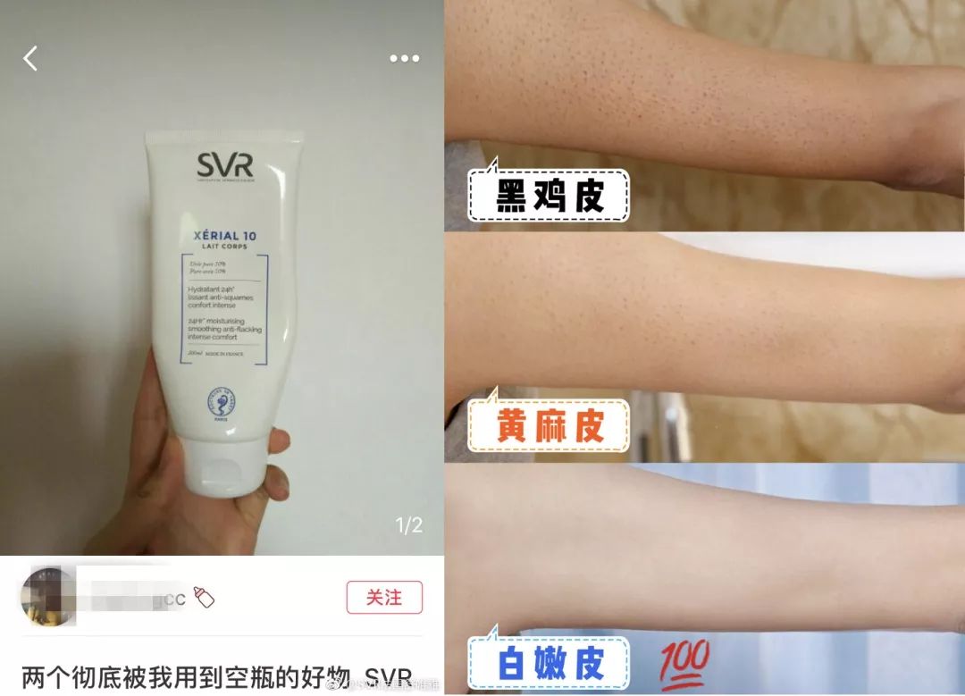 别放弃，烦人的“鸡皮疙瘩”，真的还可以再救一下