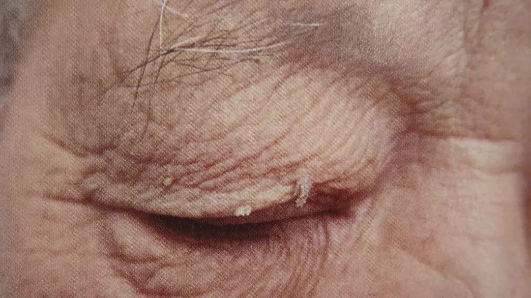 脸上长小肉揪揪用什么能抹下去,脸上长了能挤出来白色的东西