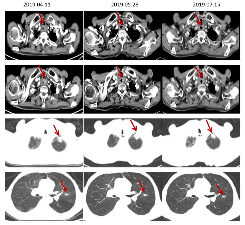 食管癌樊青霞,樊青霞讲食道癌