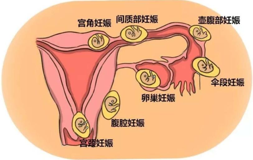 停经了吃什么能恢复,停经后腺肌症能自愈吗