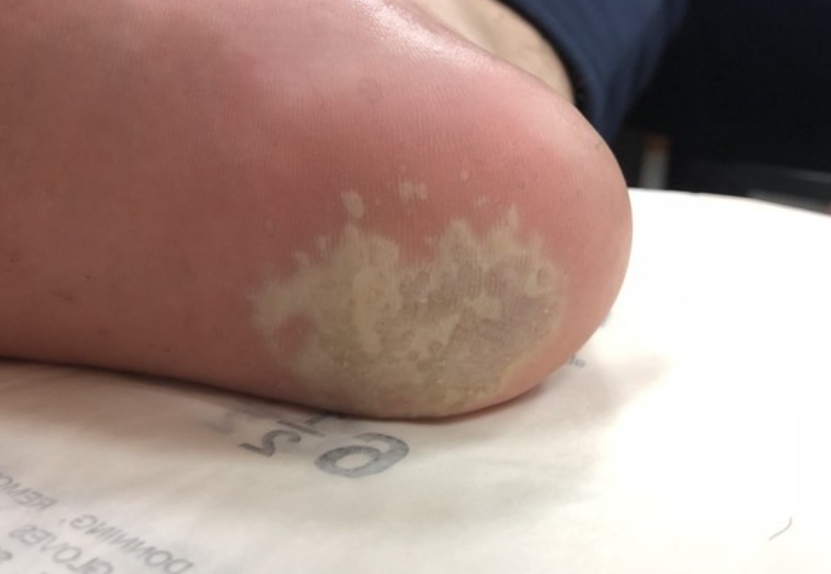 20条咸鱼上身！17岁男脚底长「白蒸蛋」医一看吓坏