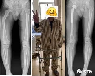 【提醒】先别悲观！骨转移瘤不是治疗的起点，此法值得被重视