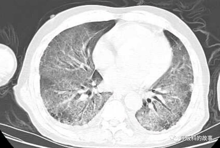 输盐水的目的,生病输盐水有什么用