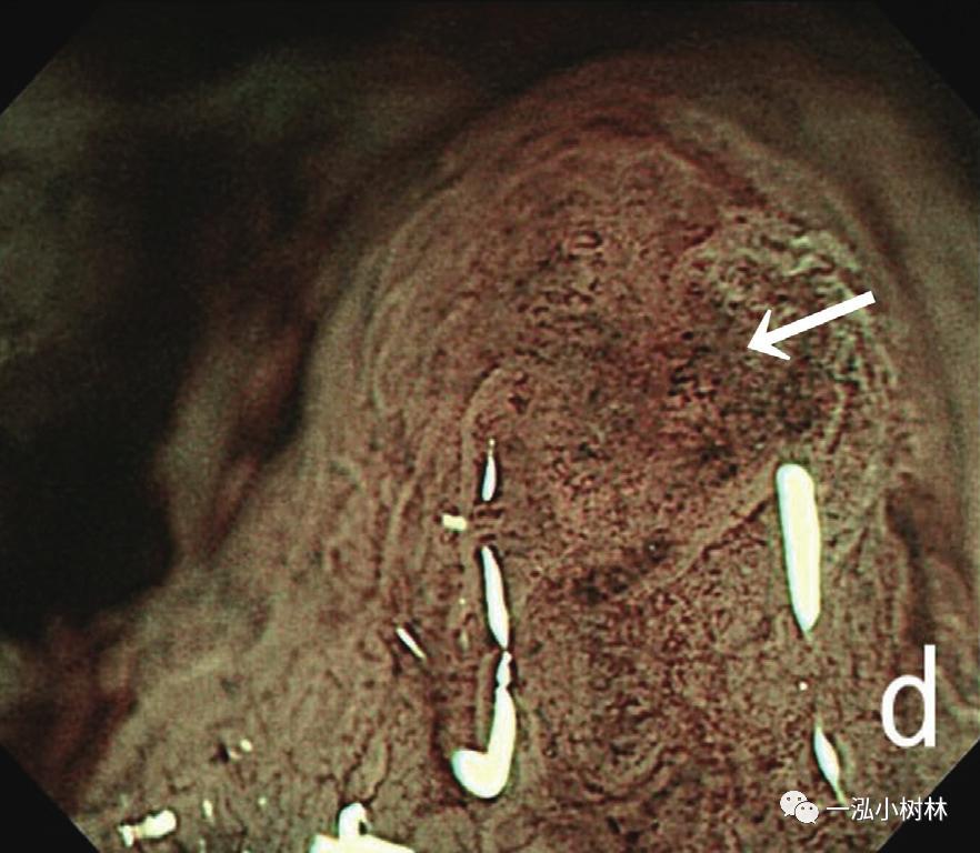 胃高级上皮内瘤变内镜案例,胃局灶性淀粉样变性预后