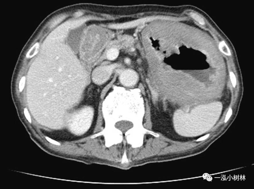 胃高级上皮内瘤变内镜案例,胃局灶性淀粉样变性预后