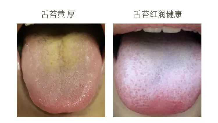 口臭痘痘胃脘疼便秘,痘痘多口臭怎么办