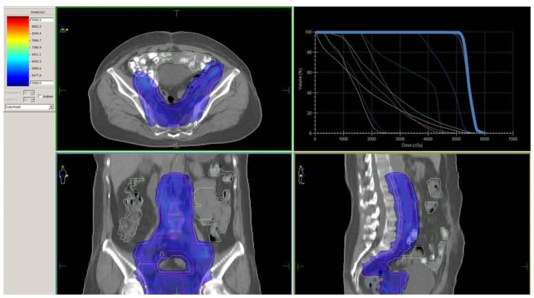 曹新平教授组稿|欧阳翼：宫颈癌的放射治疗