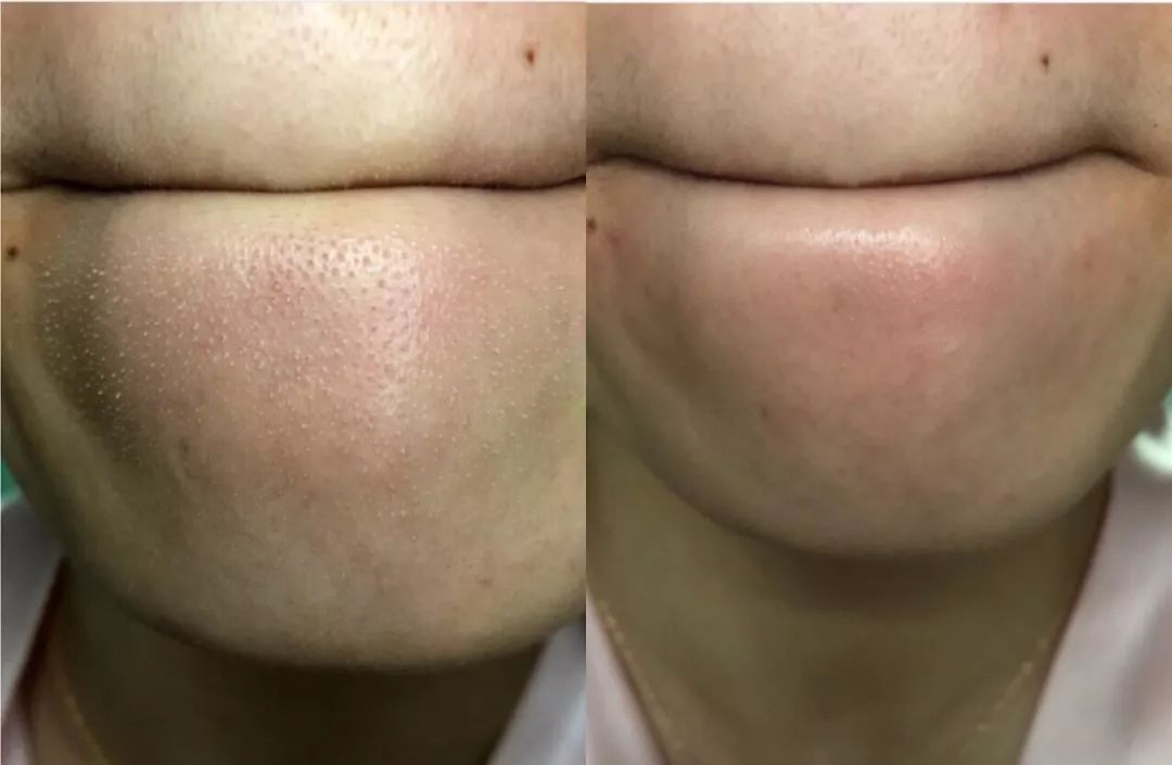 鼻头痘痘挤出来的白色物质是什么,团状红痘痘