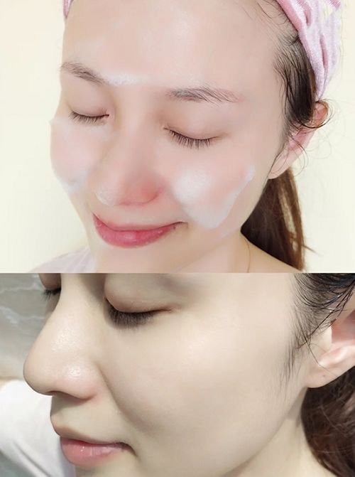 鼻头痘痘挤出来的白色物质是什么,团状红痘痘