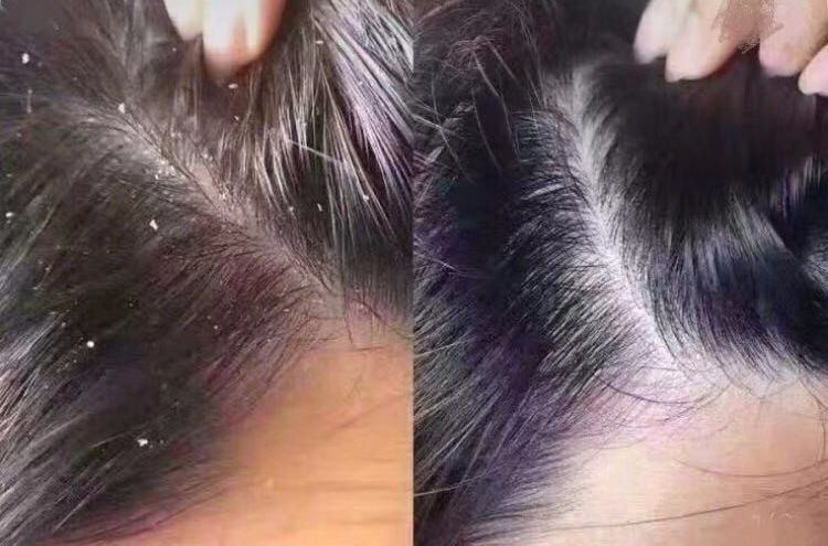 鼻头痘痘挤出来的白色物质是什么,团状红痘痘