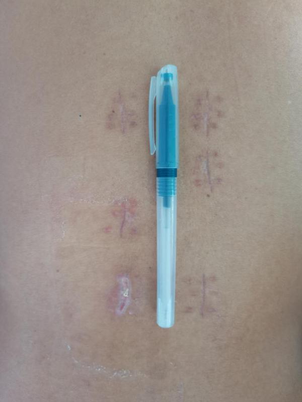 微创手术治疗胸腰椎骨折,腰椎骨折微创手术