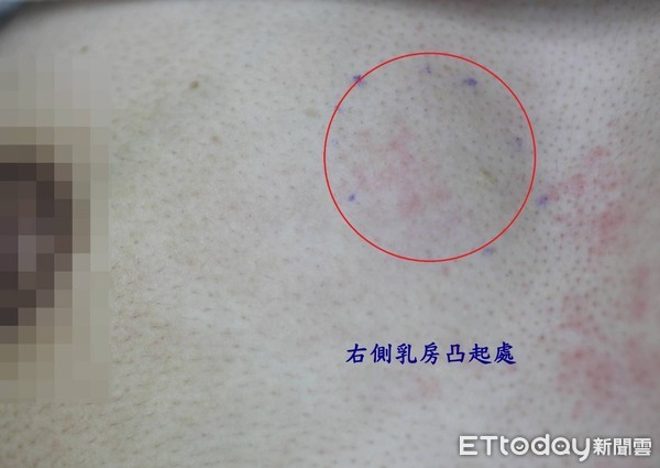 怀孕后期乳腺外边突然出现肿块,怀孕期间乳房会长出结节吗