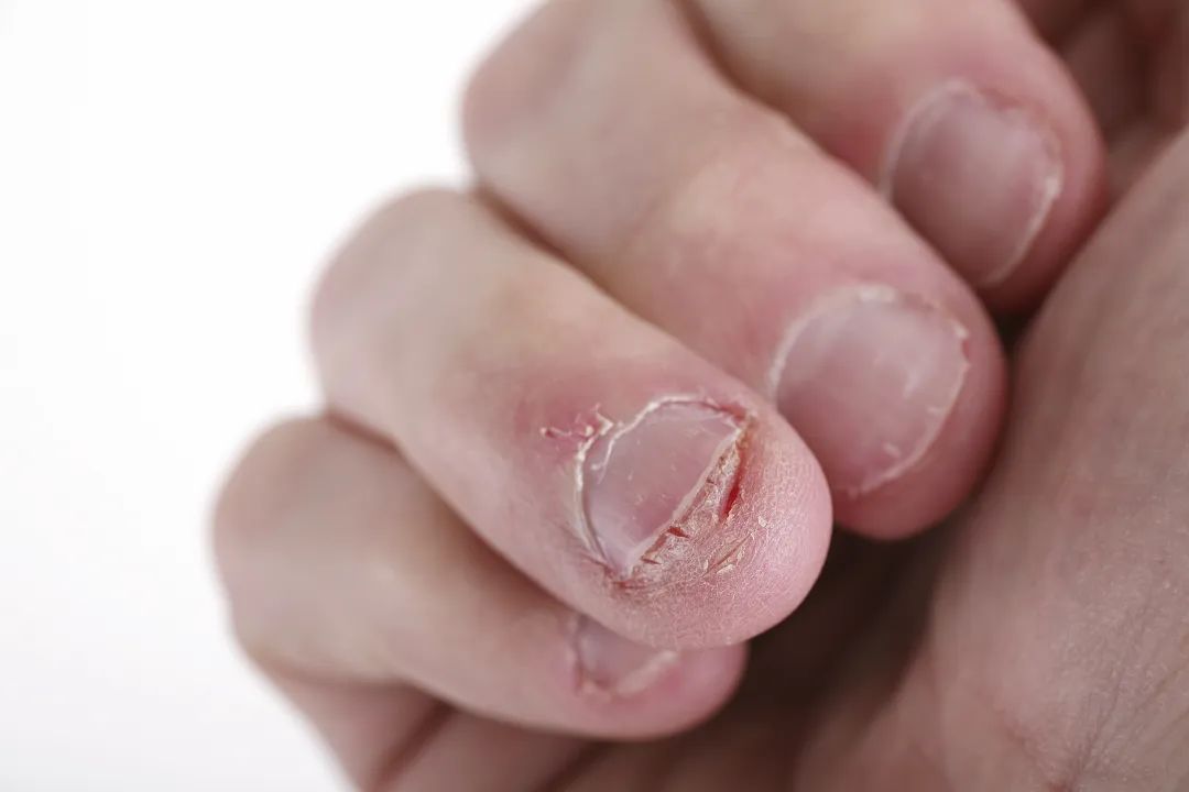 美甲的致命危害,美甲的禁忌和关注事项