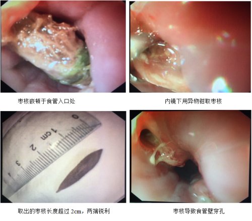 端午节吃枣要小心,端午节吃粽子慎防食用返青粽