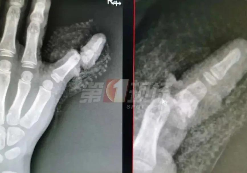 孩子手指被门夹伤怎么赔偿,孩子手指被小区自动门夹断