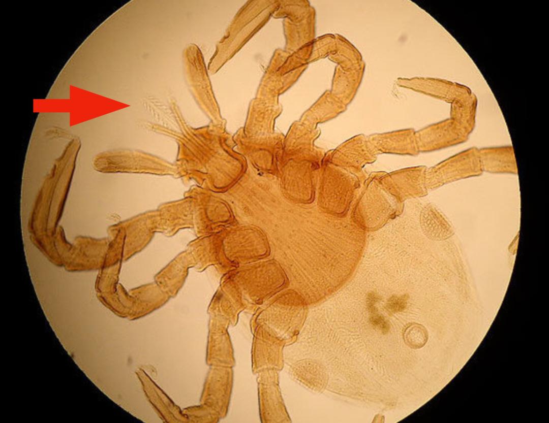 虫子爬到身体里,虫子爬到后背皮肤里面去了